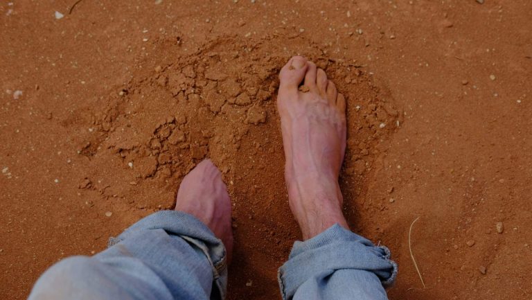 Flat Valgus Foot